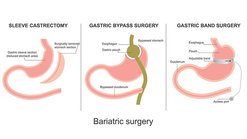 What Actually Counts as Bariatric Surgery-Separating Fact from Myths