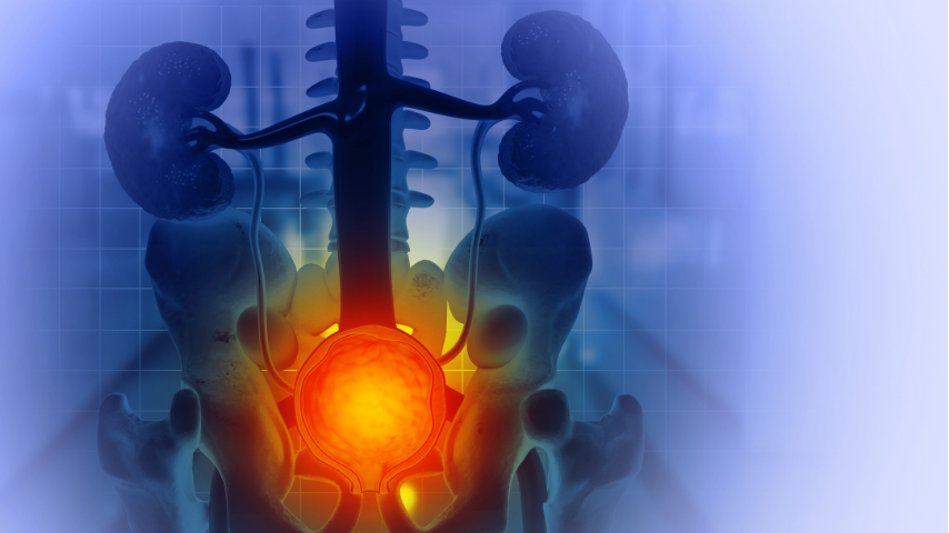 What Happens During a Prostate Tumour Ablation