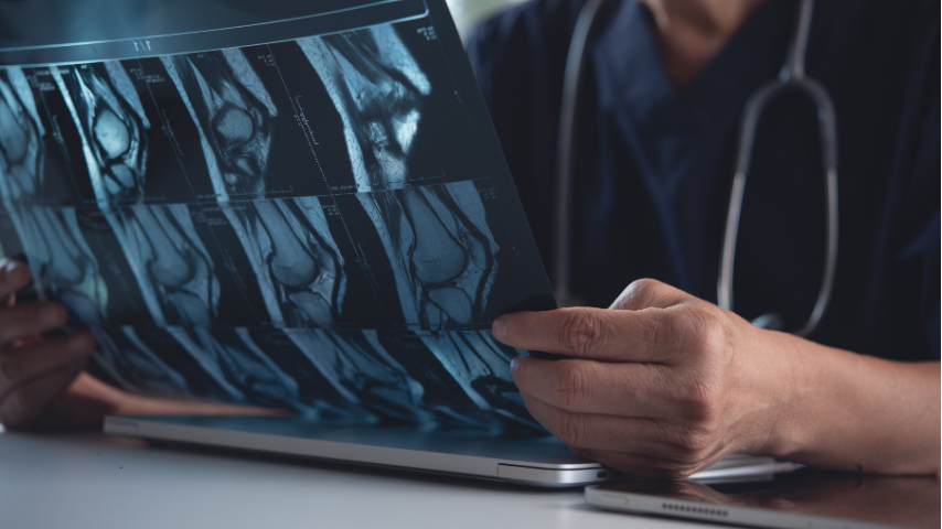 Pre-hab What Exercises Should I Do Before ACL Surgery to Improve Recovery