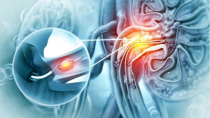 Shockwave vs. Laser vs. Ureteroscopy-Which Kidney Stone Removal Method is Right for You
