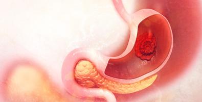 What is Stomach Cancer Treatments, Surgery & More