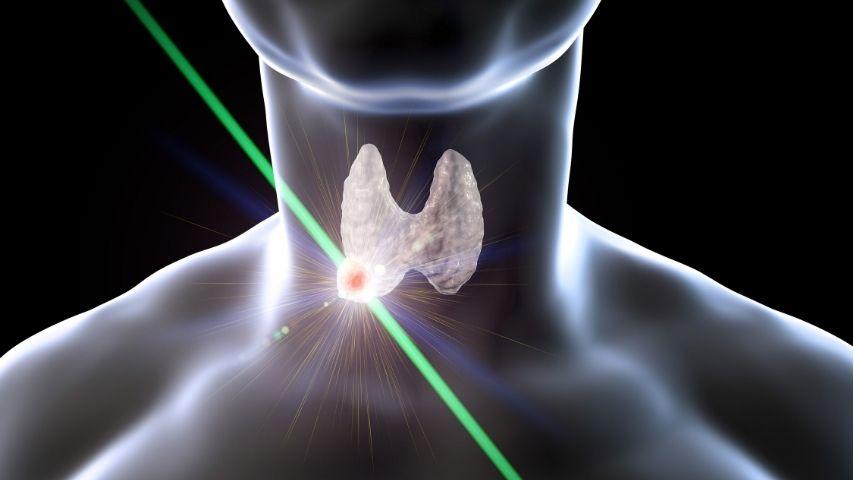 Thyroid Ablation Journey-What It&rsquo;s Like Before, During and After