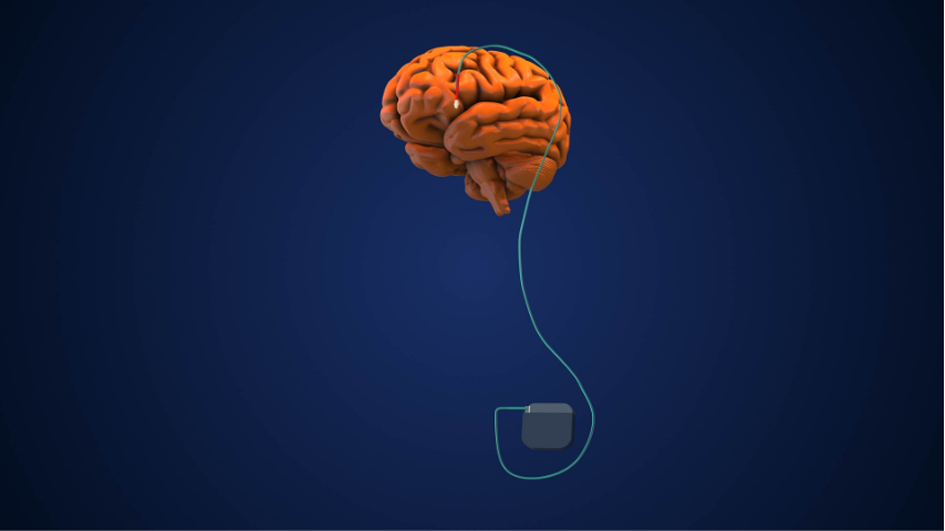 The Unexpected Side Effects of Epilepsy Surgery