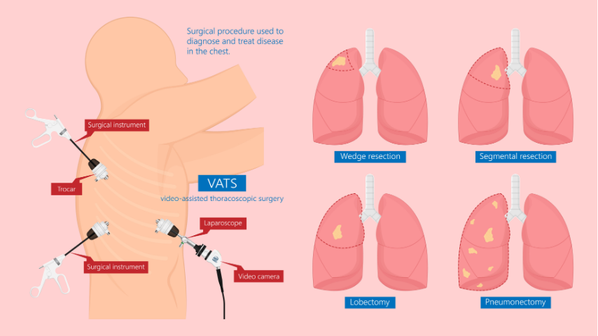 Lobectomy_vs_Segmentectomy_vs_Wedge_Resection