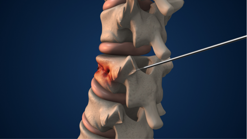 Understanding Kyphoplasty & Vertebroplasty- How They Work and Who They Help