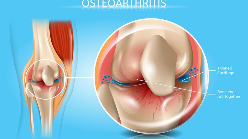 What Is Osteoarthritis Types, Treatments & More
