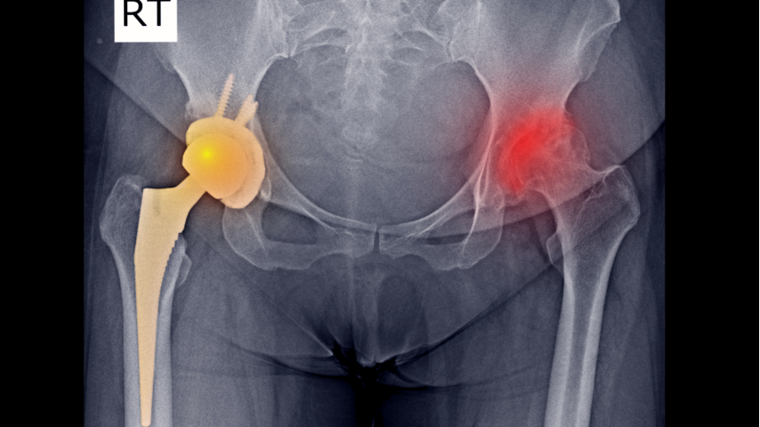Is Bilateral Hip Replacement Simultaneous or Staged Pros and Cons