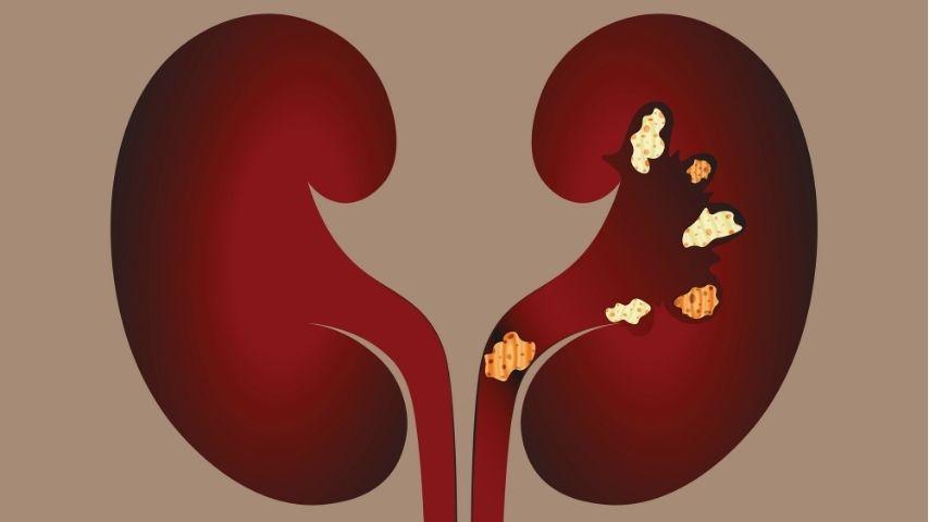 Can Small Kidney Stones Pass on Their Own- What You Should Know Before Worrying