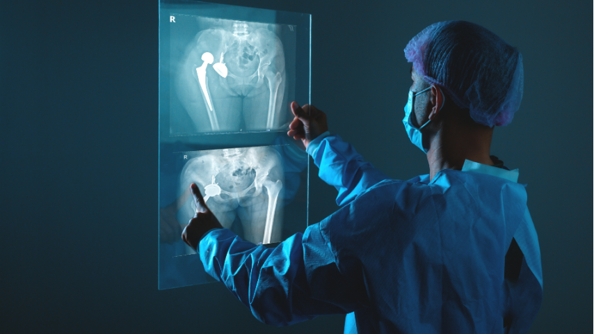 What Happens When Things Go Wrong- Managing Complications After Revision Joint Surgery