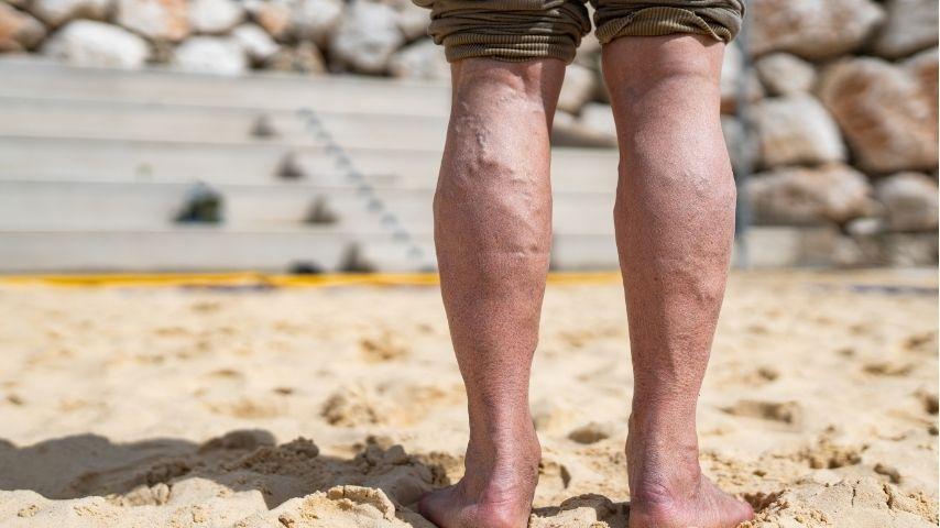 From Standing All Day to Leg Pain &mdash; Why Varicose Veins Happen (Risk Factors & Prevention Tips)
