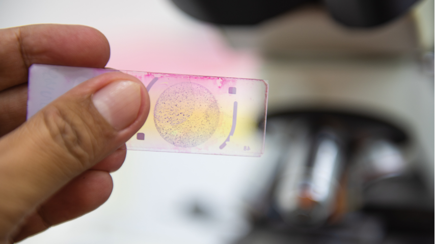 Biopsy Results Are In-What Questions Should I Ask Before Next Steps (Ablation, Surgery or Watch-and-Wait)