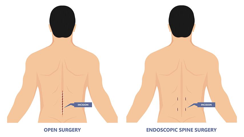 Comparing-Key-Hole-vs-Mini-Open-vs-Full-Open-Spine-Surgery--Which-Suits-Your-Condition-Best
