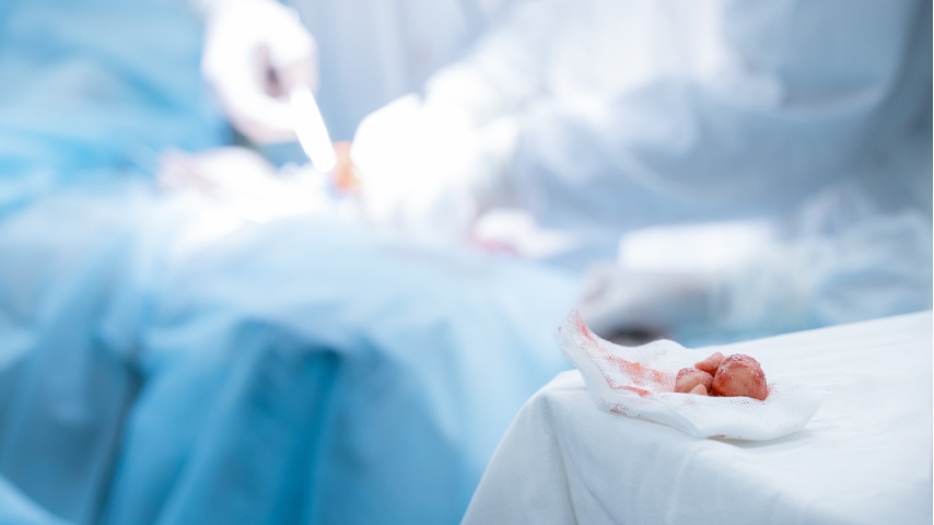 When RIRS Fails or Residual Fragments Remain- What Are the Next Steps