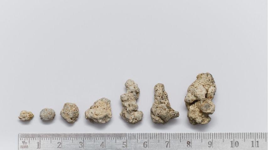 When to Opt for Surgery vs. Monitoring for Kidney Stones- A Clear Guide