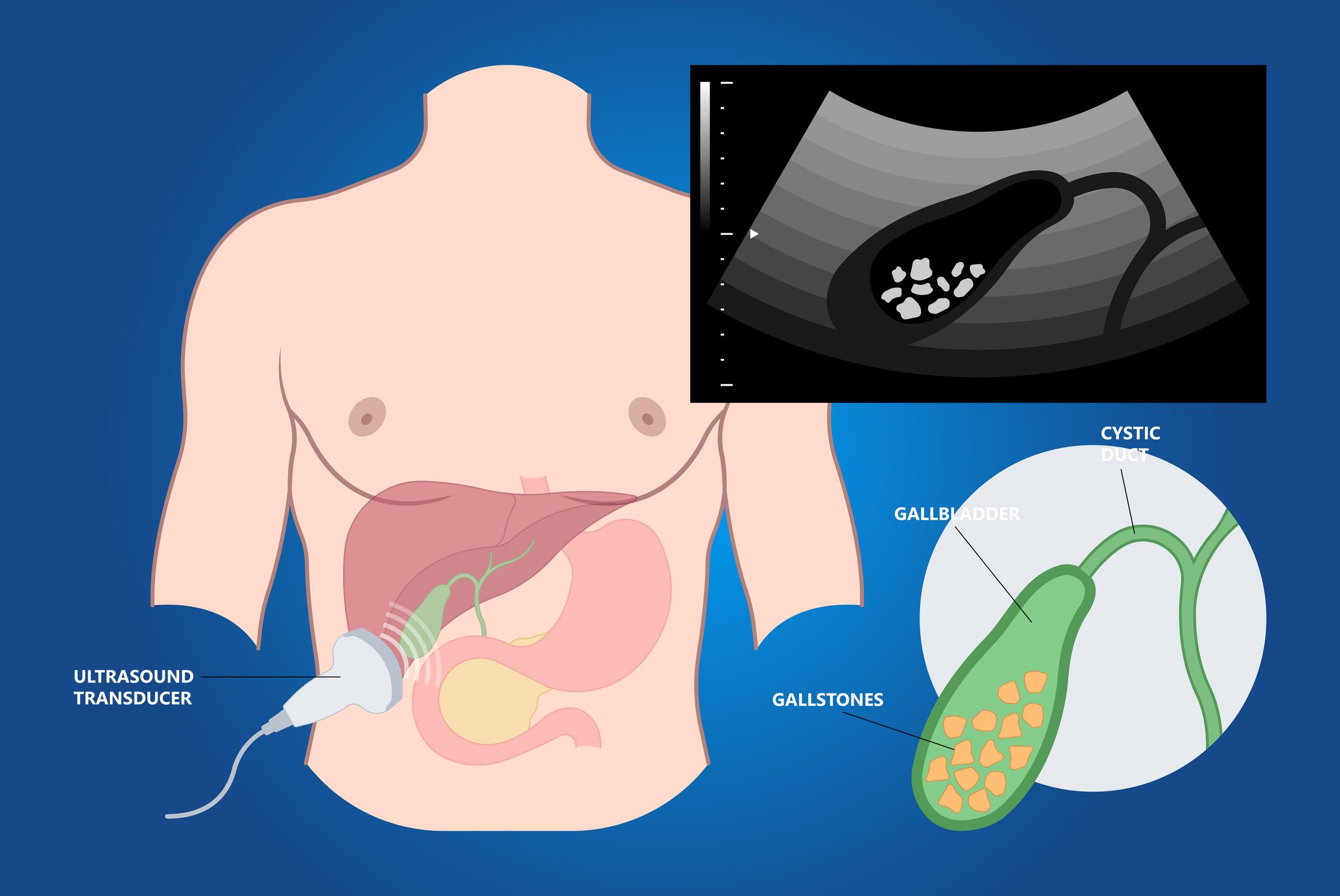 laparoscopic sleeve