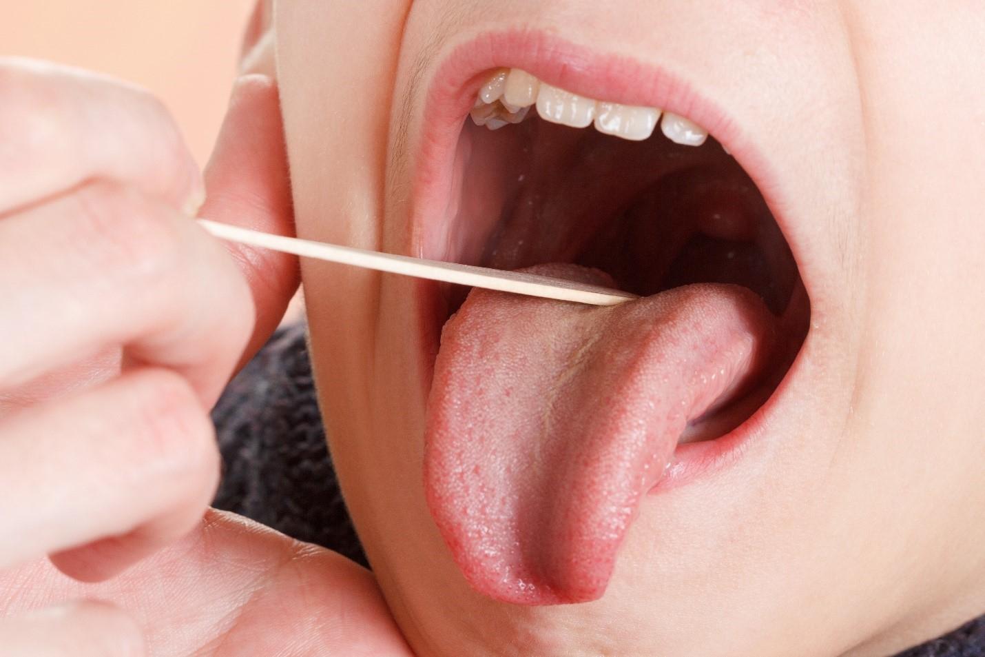 What is Tonsillitis Symptoms, Types & Treatment