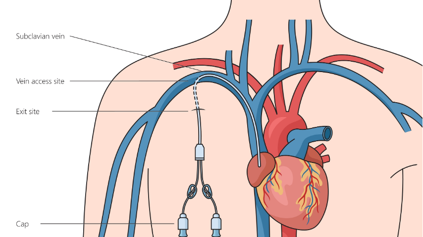 What Exactly Is a Port or Central Line and Why Might You Need One