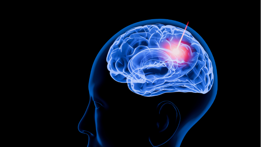 Comparing Laser Ablation vs Open Resection vs Neuro-Stimulators for Epilepsy
