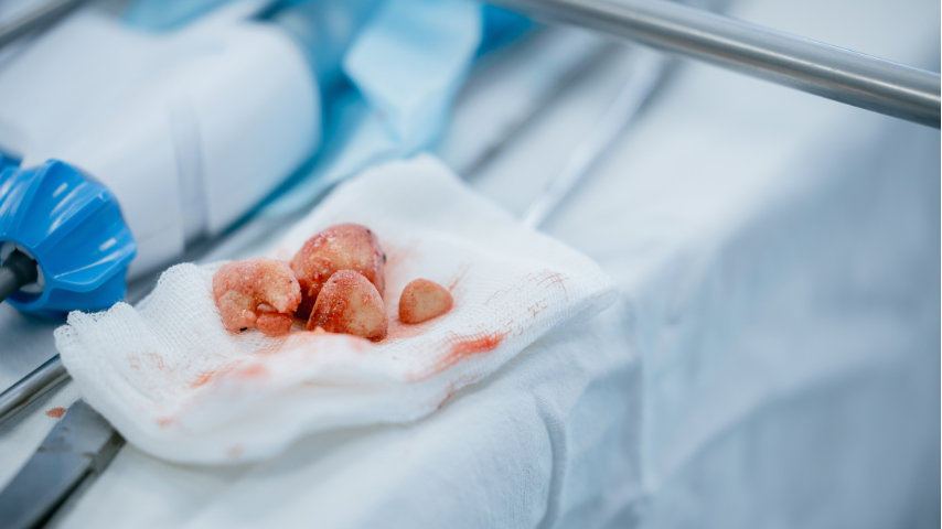 How Big a Kidney Stone Is Too Big for RIRS- Understanding Size & Outcome