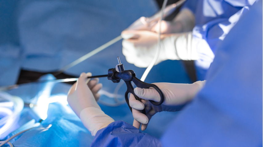 The Stent After RIRS- How Long, How Much Discomfort & How to Manage It