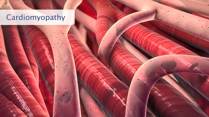 What is Cardiomyopathy Causes, Symptoms & Treatment