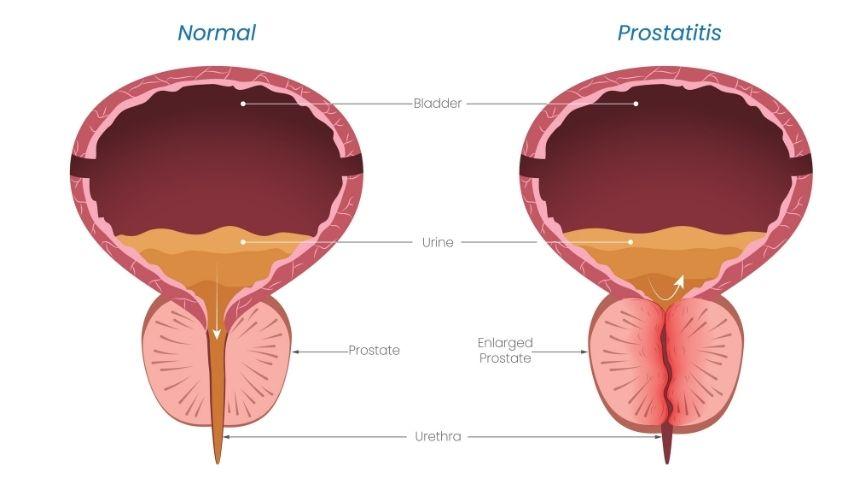 How Effective Is PAE for Enlarged Prostate-Results, Prostate Shrinkage and Symptom Relief You Should Know