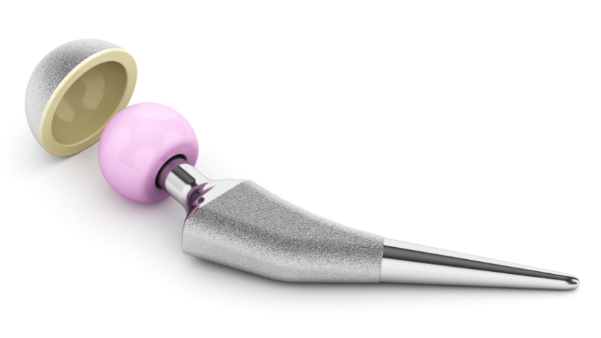 Risks, Costs & Hidden Factors in Hip-Knee Revision Surgery You Must Know