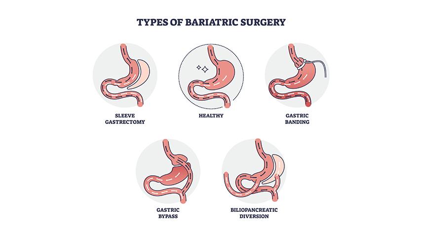 Which Procedure Should I Choose- Sleeve vs Bypass vs Balloon&mdash;What&rsquo;s Right for Me