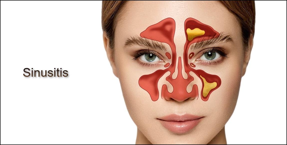 Sinusitis (Sinus Infection) Symptoms, Treatment & More