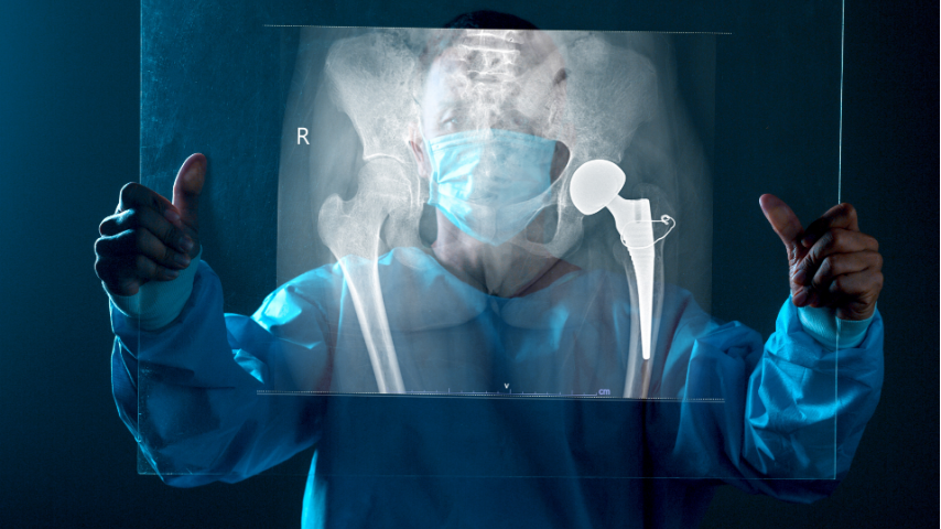 Hip Replacement vs Hip Resurfacing Pros, Cons, and Who’s Best Suited for Each