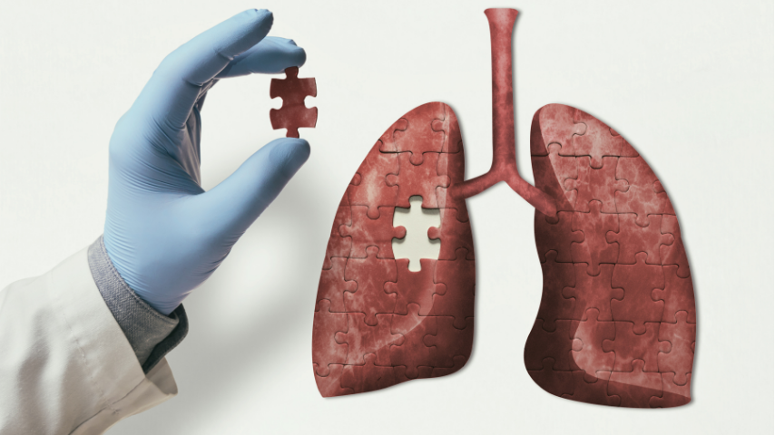Lobectomy_Recovery_Timelines