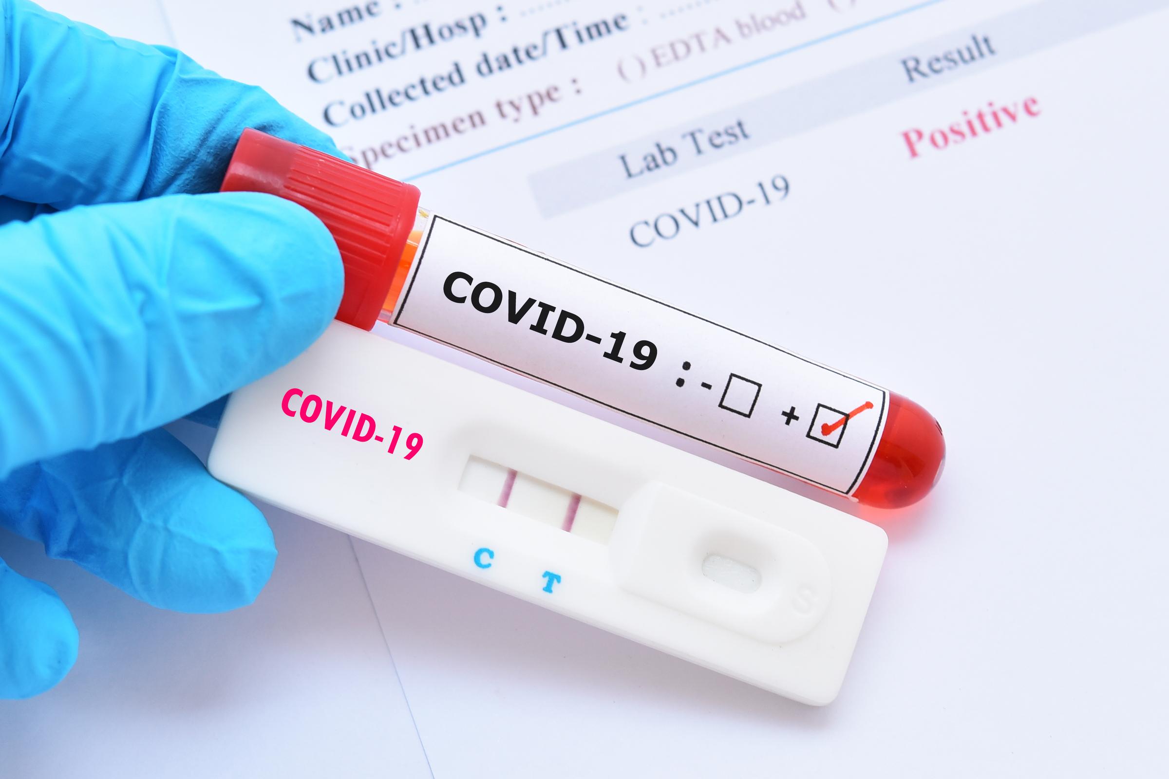 COVID-19 Tested Negative Or False-Negative?