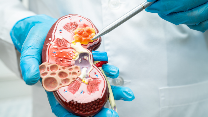 Can Everyone with Kidney Disease Expect Dialysis- Debunking the Myths
