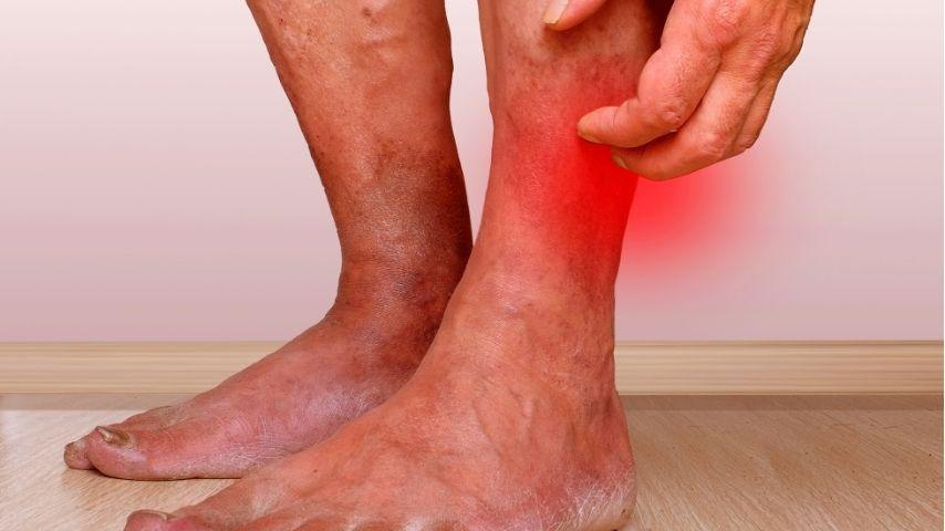 What Are Varicose Veins and Venous Ulcers &mdash; And When Should You Consider Interventional Radiology