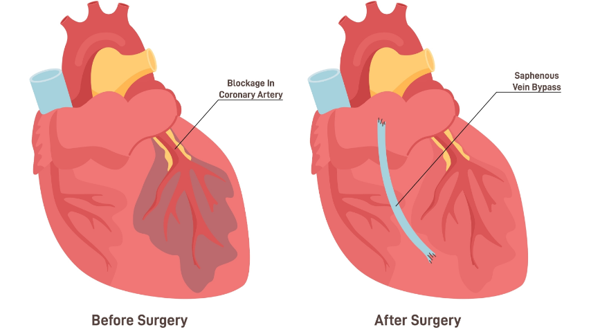 Coronary Artery Bypass Graft Made Simple What You Need to Know
