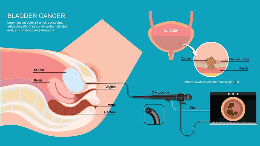 Can prostate size growth be slowed without surgery-When to start thinking about procedures like laser TURP - 1