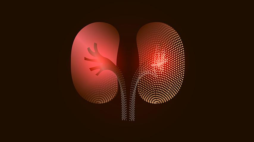 Managing Pain, Fatigue and Side Effects While on Dialysis- What Works - 1