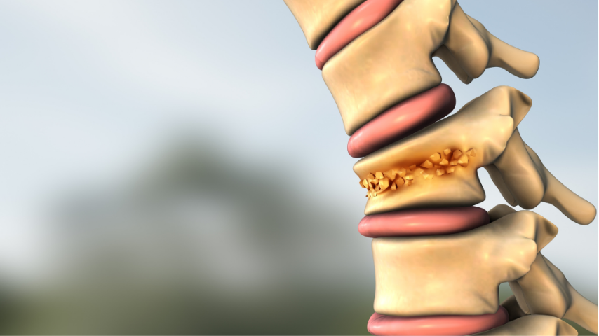 Choosing Between Kyphoplasty Devices & Techniques- What Clinicians and Patients Discuss (Balloon vs SpineJack vs Cement Types)