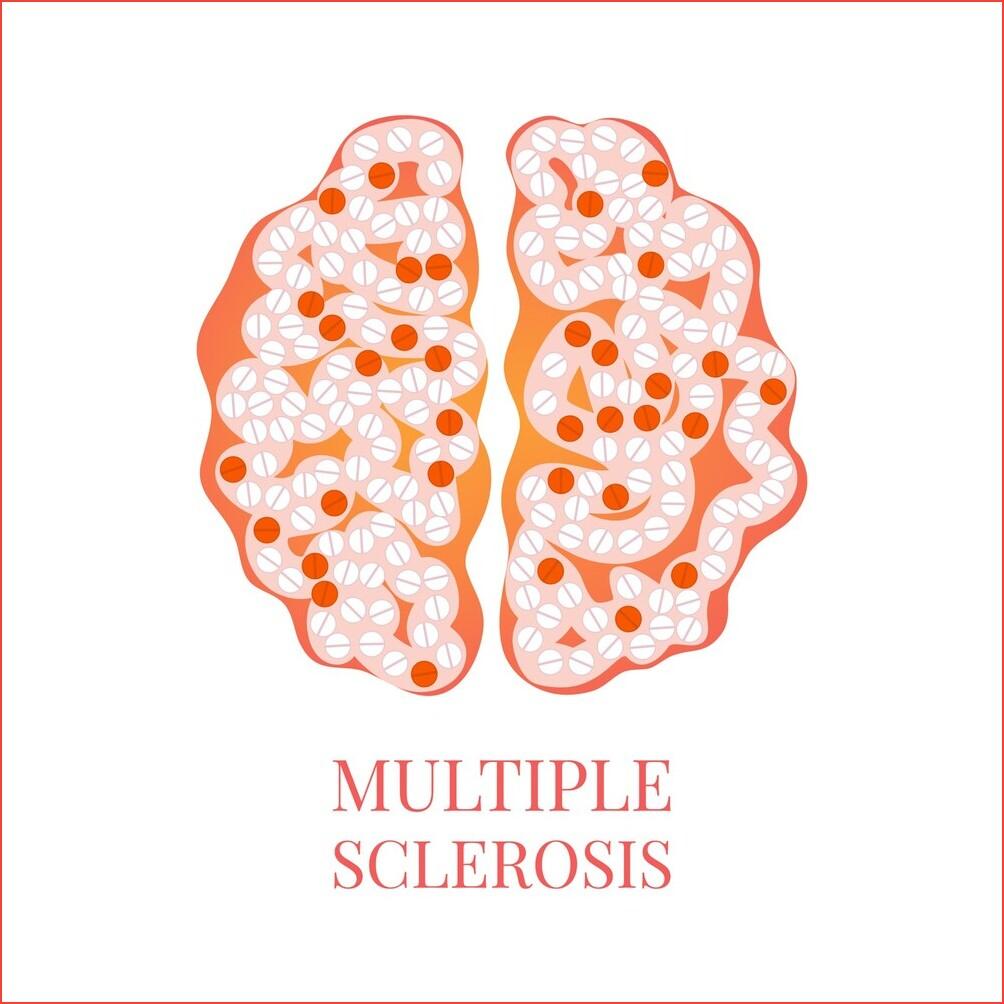 What Is Multiple Sclerosis Its Type, Symptoms, Treatments & More