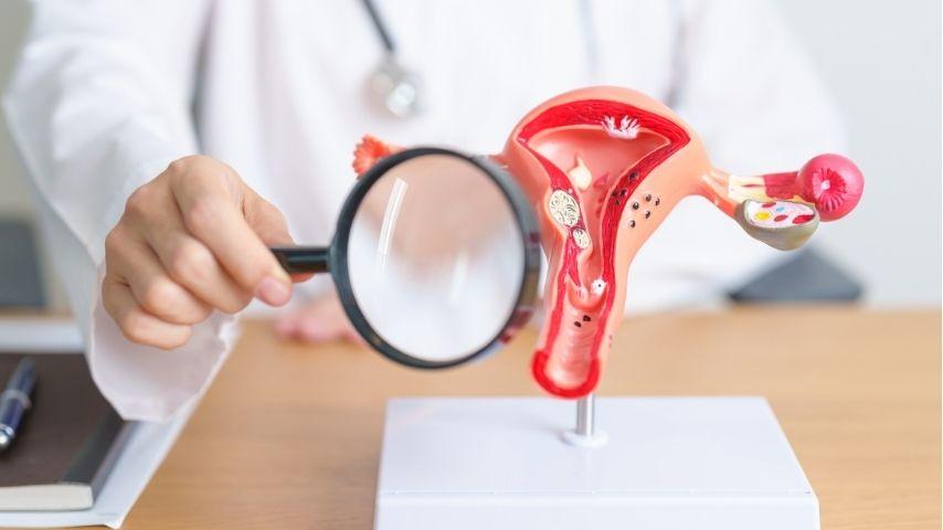 Uterine Fibroids vs Uterine Embolization (UFE)-What It Is and When It’s Considered