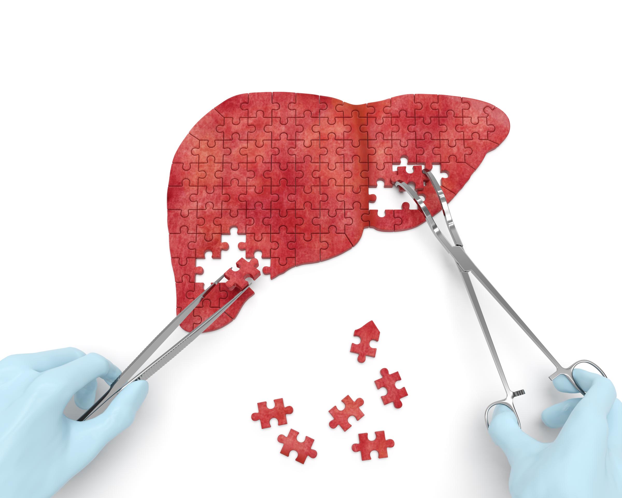 Transarterial Chemoembolization (TACE)