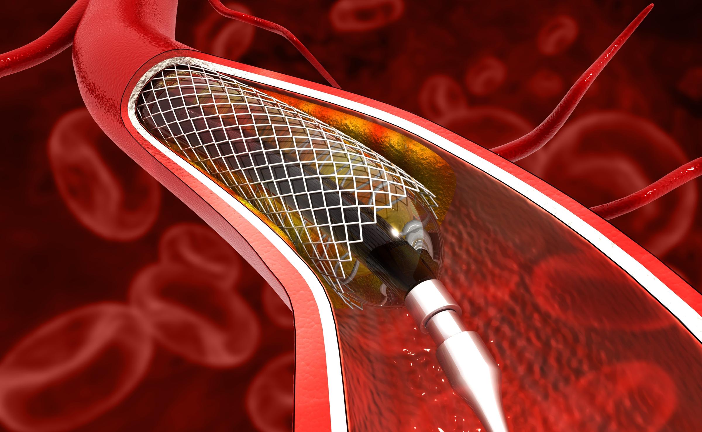 Understanding Angioplasty