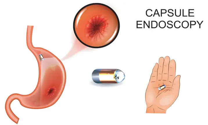 Endoscopi - SECURDET