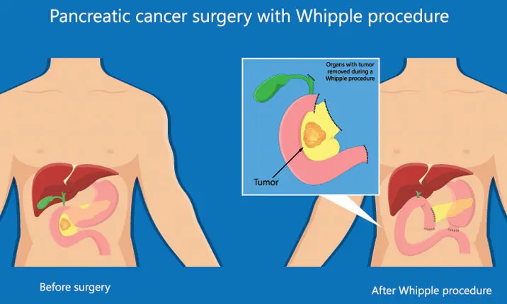 Pancreatic cancer whipple procedure