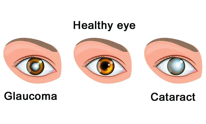 Only elders are at risk of glaucoma or cataracts