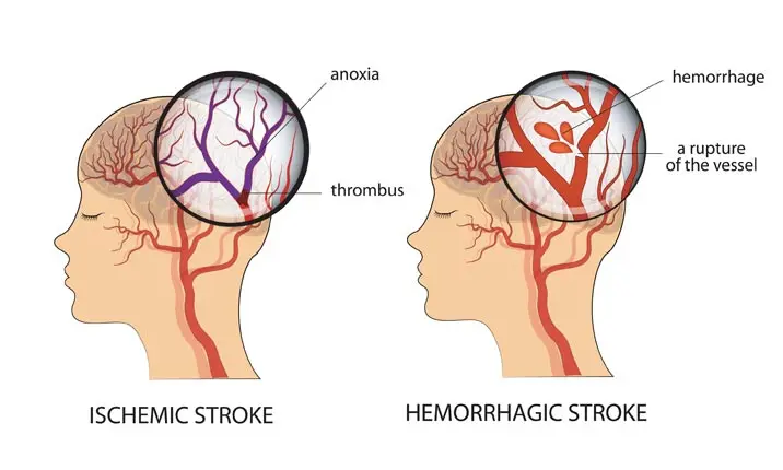 What is a stroke?