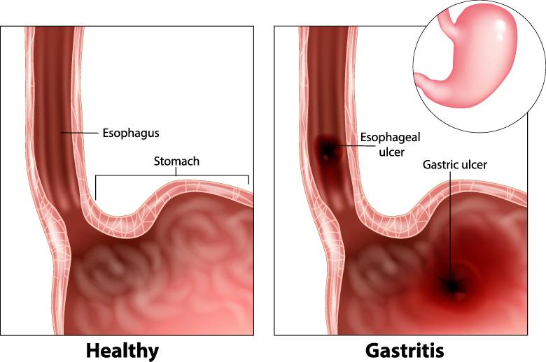 Gastritis may cause oesophageal ulcers and gastric ulcers in the stomach.