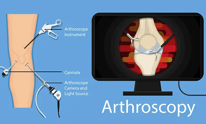 Joint arthroscopy tendinitis