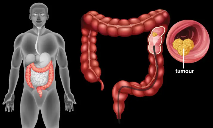 colon cancer stool pictures