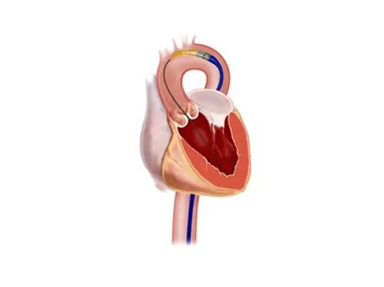 transcatheter-heart-valve.tmb-210x133